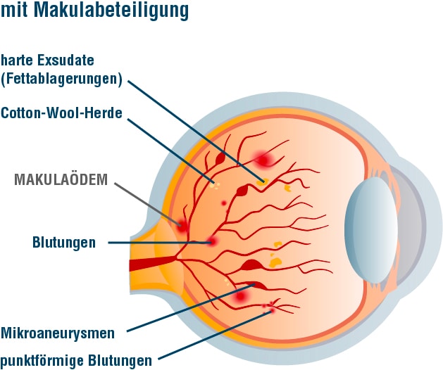 Grafik_Retinopathie_nicht-proliferativ_mit_Makula