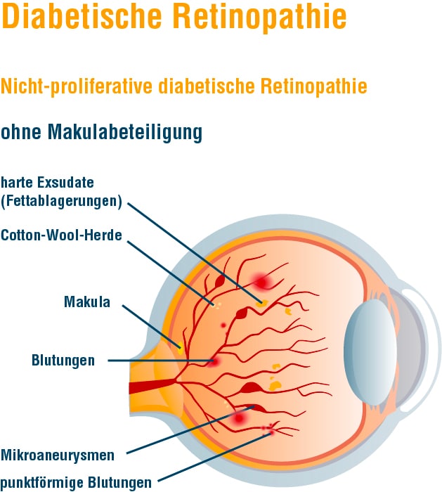 Grafik_Retinopathie_nicht-proliferativ_ohne_Makula