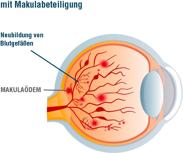 Grafik_Retinopathie_proliferativ_mit_Makula