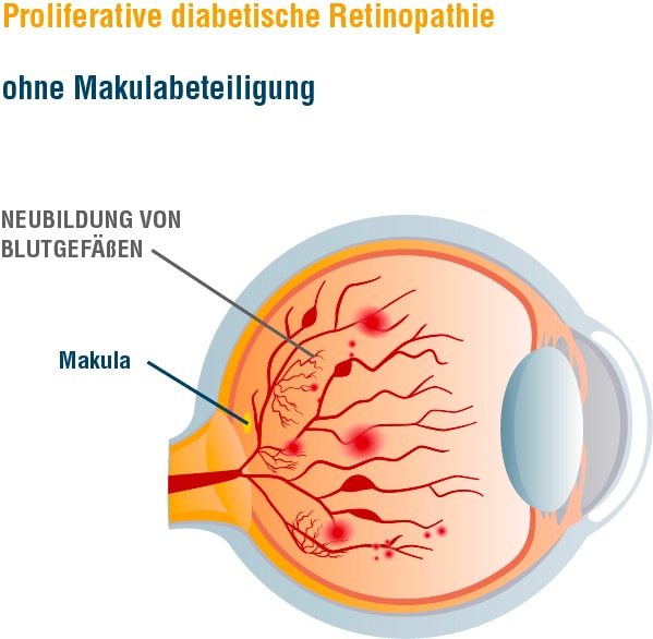 Grafik_Retinopathie_proliferativ_ohne_Makula