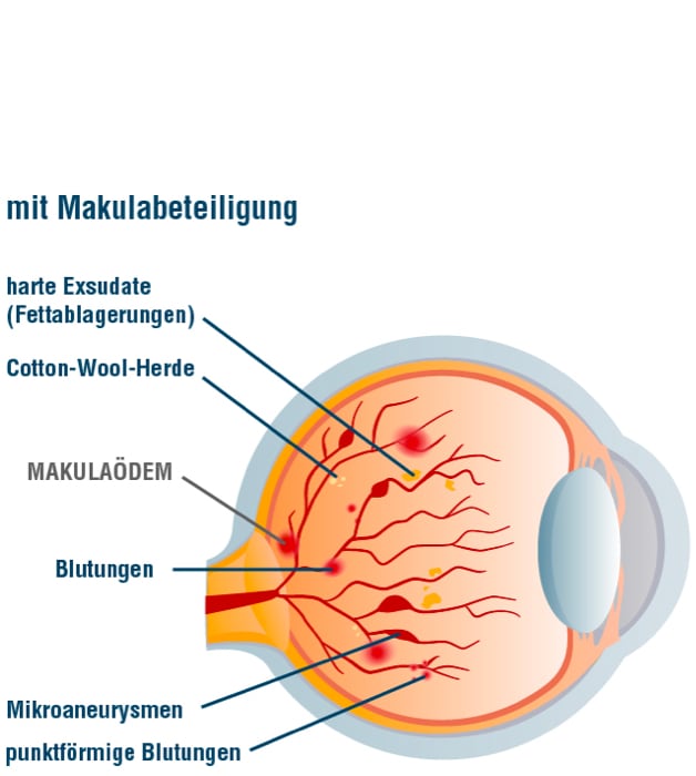 Grafik_Retinopathie_nicht-proliferativ_mit_Makula