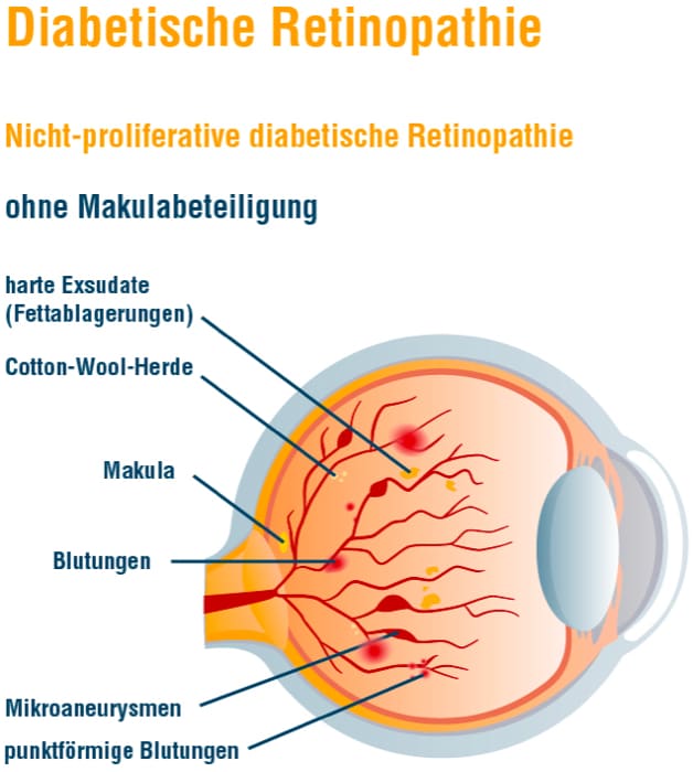 Grafik_Retinopathie_nicht-proliferativ_ohne_Makula