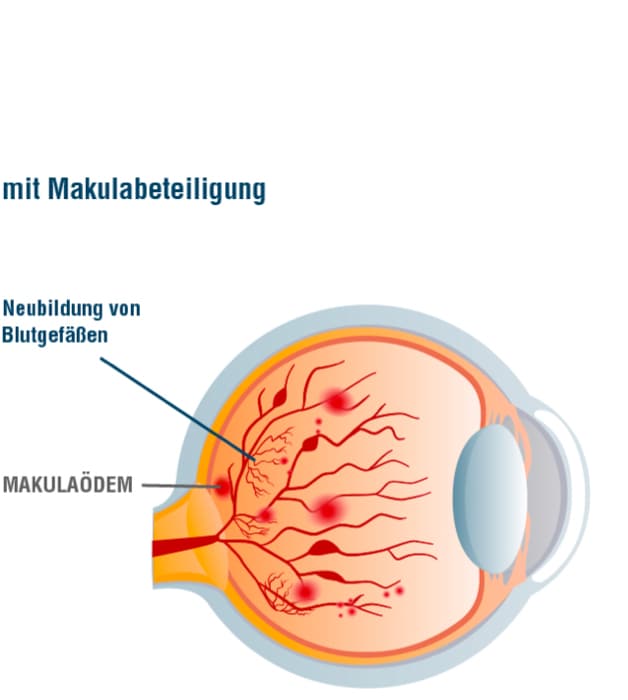 Grafik_Retinopathie_proliferativ_mit_Makula