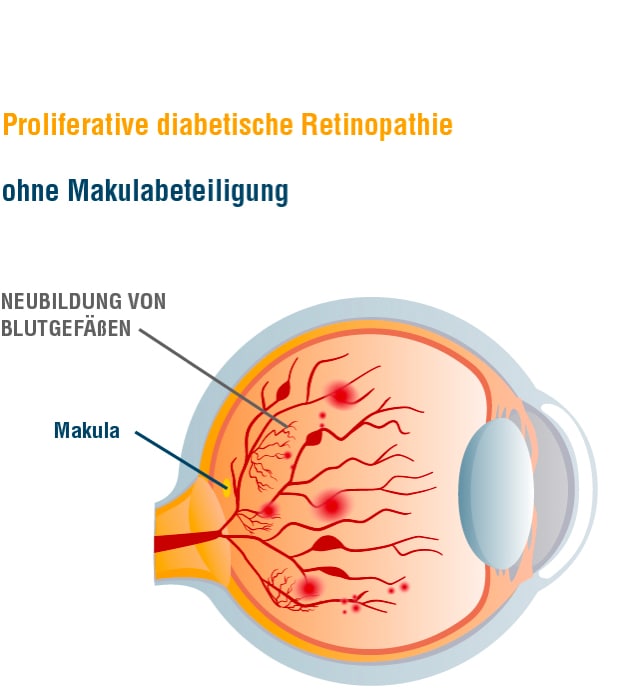 Grafik_Retinopathie_proliferativ_ohne_Makula